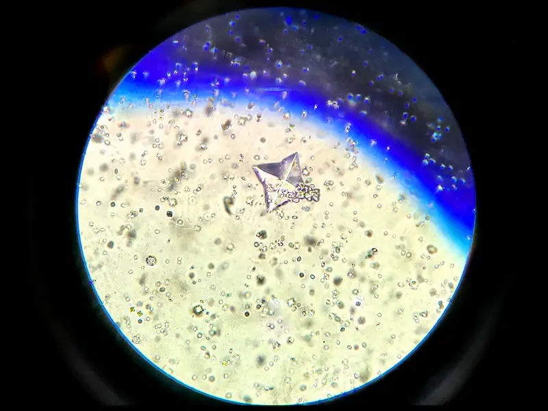 Crystals in Urine Understanding Causes and Treatment